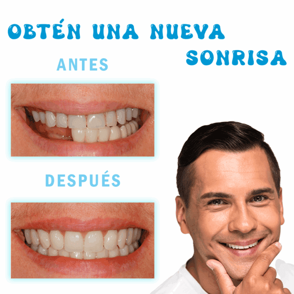 Resina Moldeable para Reparación Dental - Imagen 3